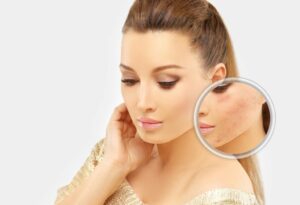 Acne Scar Treatment in Los Angeles