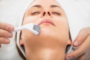 Micro needling Therapy