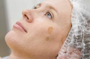 Oncology Facial in Encino